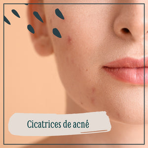 ¿Sabes qué hacer para evitar las cicatrices del acné?