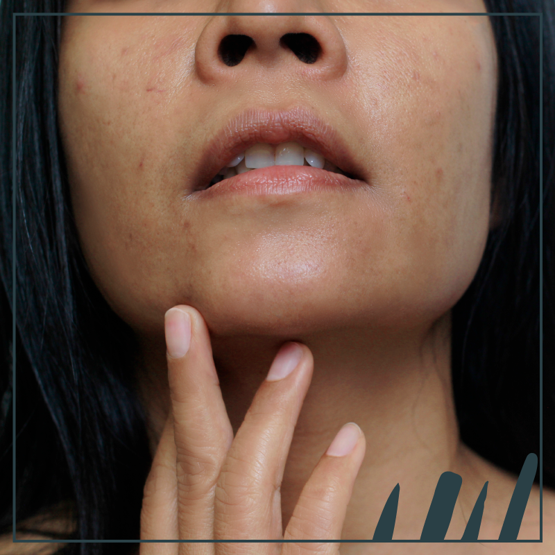 Manchas cutáneas en el embarazo: como evitarlas