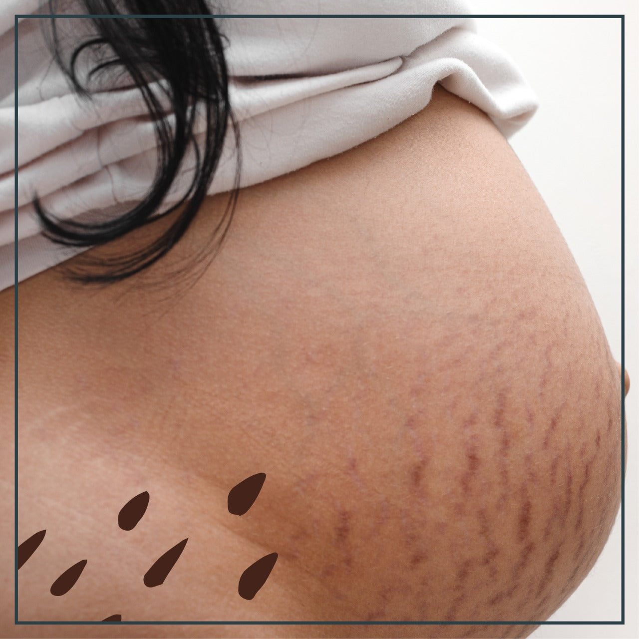 ¿Qué hacer para disminuir las estrías rojas?