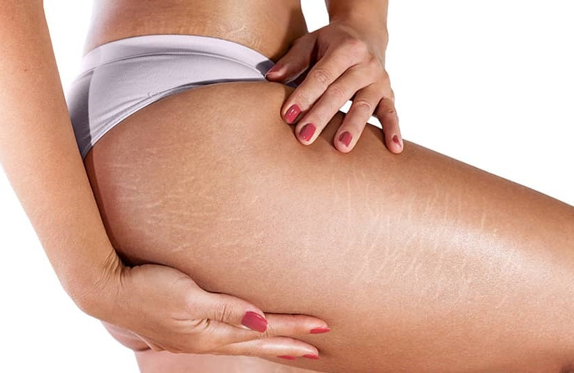 Ejercicios para eliminar la Celulitis.
