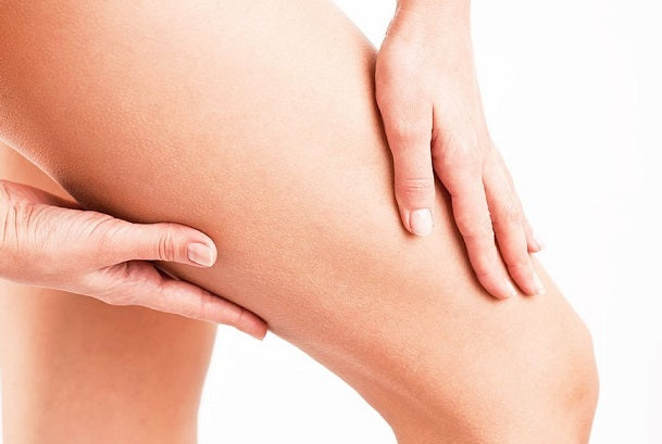 Diferencias entre las estrías y la celulitis