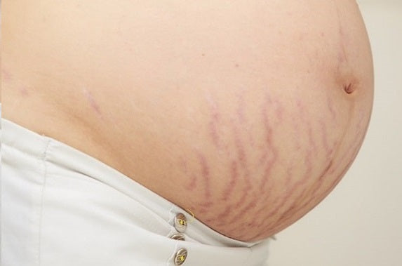 Estrías rojas en el embarazo
