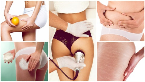 CELULITIS Y ESTRIAS: TODO LO QUE NECESITAS SABER PARA EVITARLAS