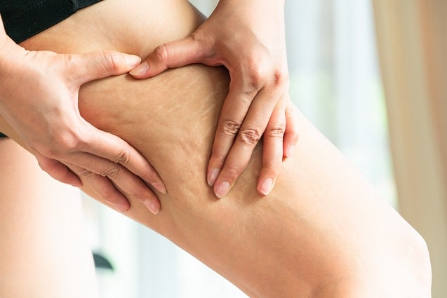 Qué son las Estrías