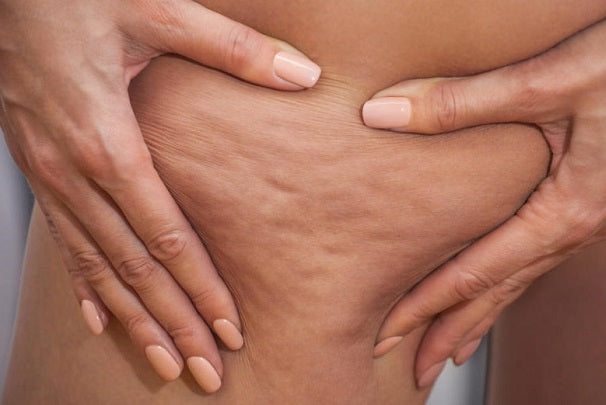 ¿Por que sale la celulitis?